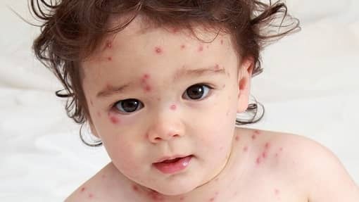 Chicken pox in baby complete body.